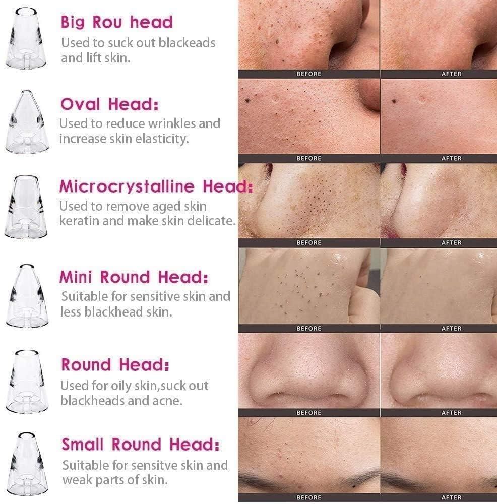 Herhaven 6 in 1 Multi-function Blackhead Remover